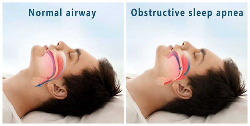 normal airway vs obstructive sleep apnea